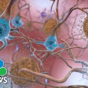 New Alzheimer’s Drug Could Signal Potential Treatment Breakthrough