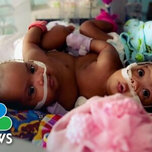 Conjoined twins separated in miracle procedure