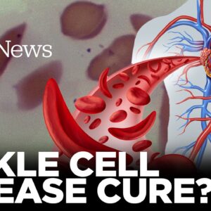 Sickle Cell Gene Therapy: FDA Likely Set to Approve